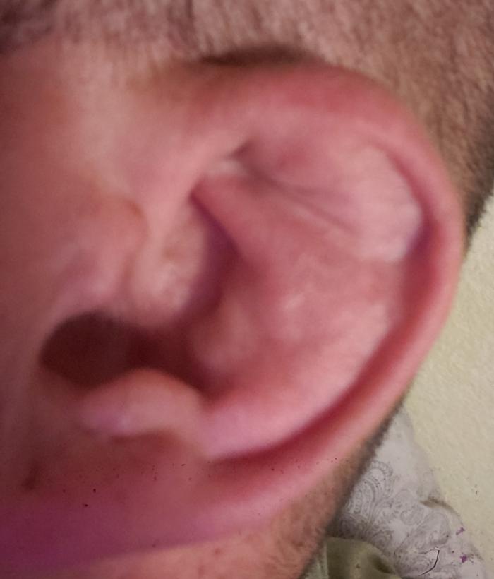 The pig embryo growing in my ear.