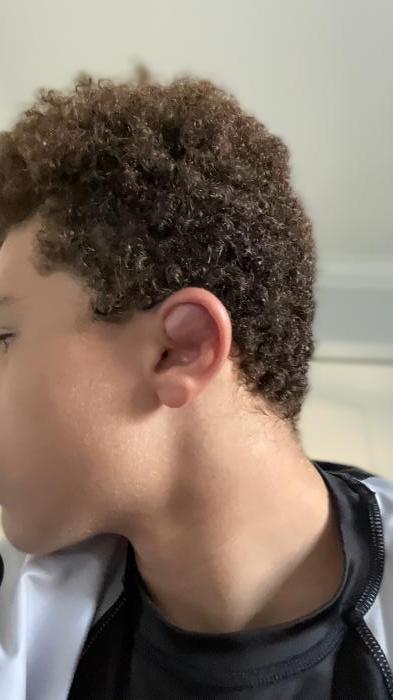 My cauliflower ear appeared :|