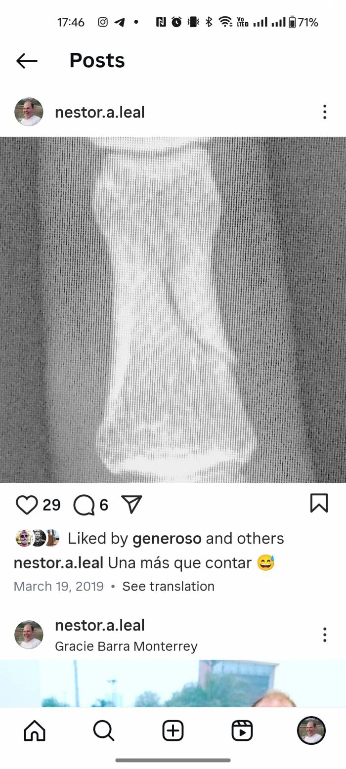 Broken Finger